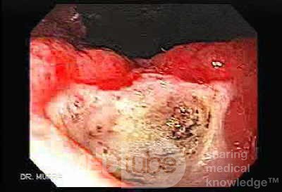 Two Ulcers in a Cirrhotic Patient - Retroflexed View