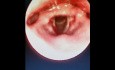 Hemorrhage in the Vocal Fold