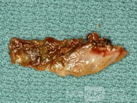 Atrophic Rhinitis Crust