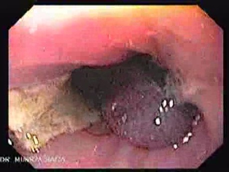 Endoscopic Variceal Ligation - Ulceration Post Ligation
