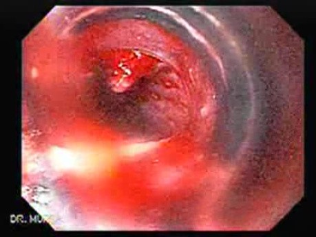 Esophageal Varix - Banding of Bleeding Varix