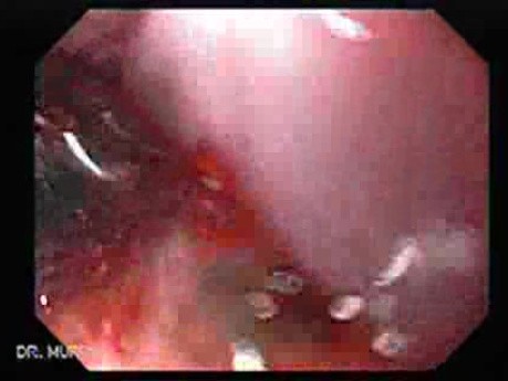 Adenocarcinoma of the Gastroesophageal Junction - Next Removal of Necrotic Tissue