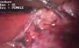 Laparoscopic salpingectomy - female