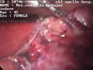 Laparoscopic salpingectomy - female