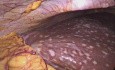 Laparoscopic Hepatic & Visceral Sarcoidosis