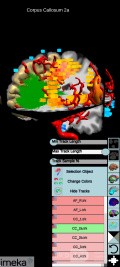 Surgical Planning with Neuronavigator in Patient with Intracranial Mass Lesion. High Grade Glioma.