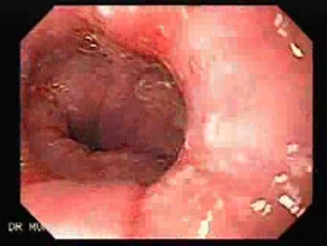 Synchronous Cancer (Gastric and Esophageal) - Assessment of the Lower Third of the Esophagus 