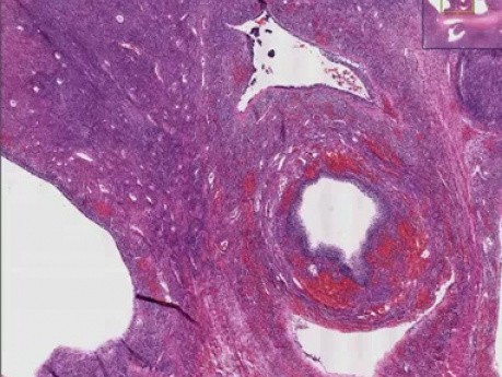 Polycystic ovarian disease