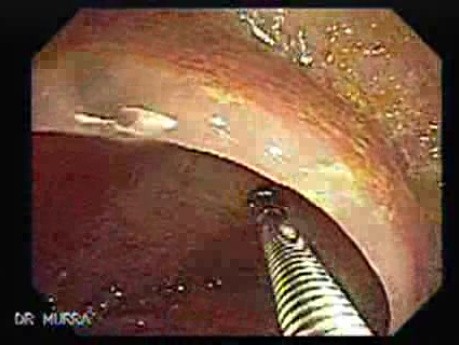 Adenocarcinoma - Cecum (4 of 4)