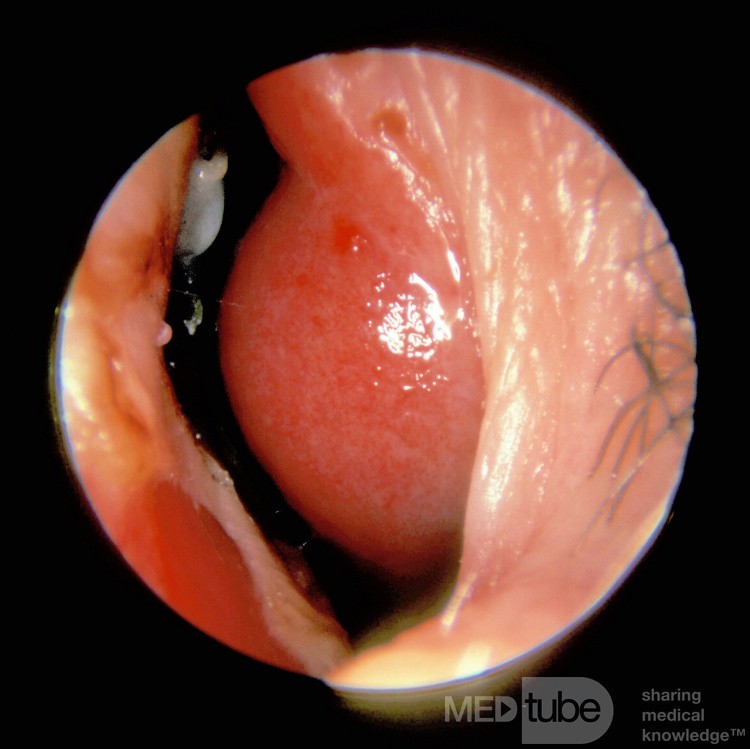 Osler Weber Rendu Disease Inferior Turbinate