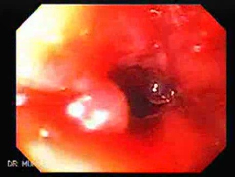 Perforation of a Esophageal Carcinoma After the Procedure with Hydrostatic Balloon Dilation - Closer Look at the Tumor