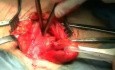 Inguinal hernia repair 