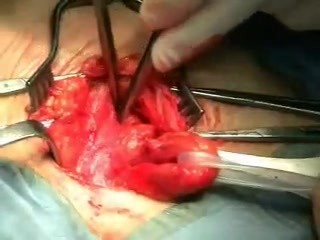 Inguinal hernia repair 