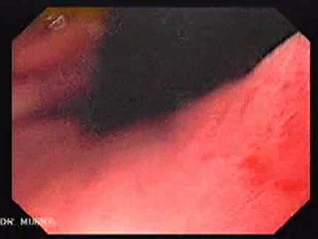 High Resolution Video Endoscopy with Zoom - Cardias and Fundus