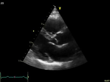 Real-Time Three Dimensional Echocardiography - Parasternal Long Axis View on Mitral Valve, Video nr 3