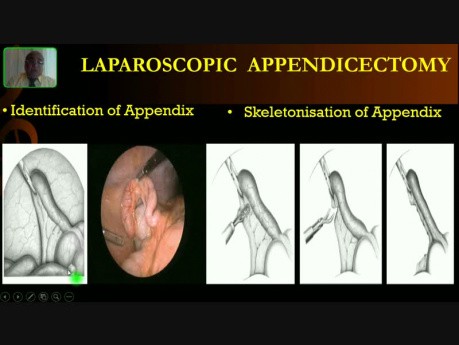 Laparoscopic Appendicectomy - Operative Surgery