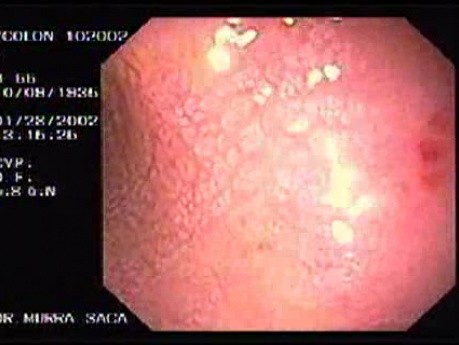 Cryptosporidiosis of Colon (1 of 3)