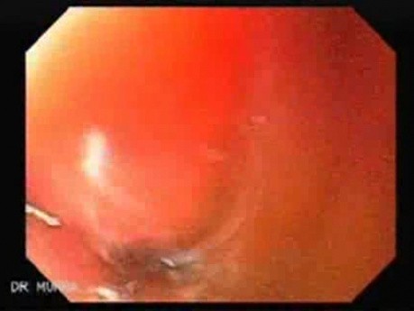 Leather Bottle Stomach - Endoscopy (3 of 9)