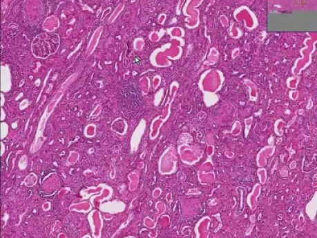 Chronic glomerulonephritis