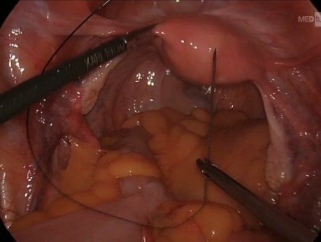 Laparoscopic Ventral Rectopexy