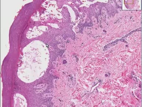 Epidermolysis bullousa