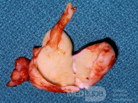 Huge Maxillary Sinus Cyst [surgical specimen]