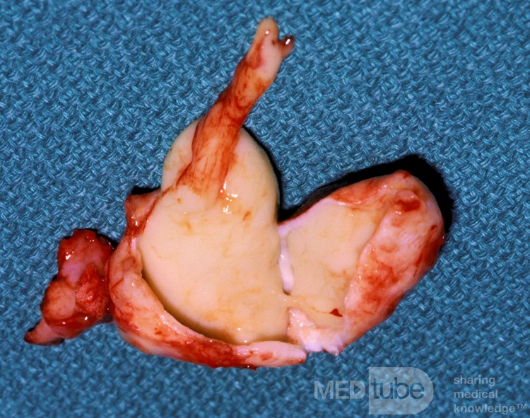 Huge Maxillary Sinus Cyst [surgical specimen]