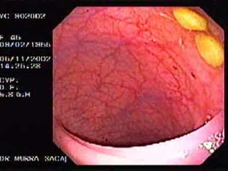 Guavas Seeds Incrusted in the Sigmoid (3 of 3)