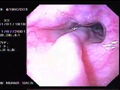 Upper Gastrointestinal Hemorrhage - First Look at the Esophageal Mucosa