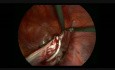 Laparoscopic Huge Ovarian Cystectomy