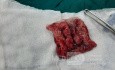 Lower Esophageal Cancer