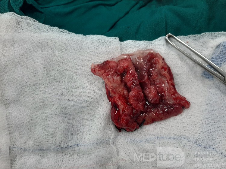 Lower Esophageal Cancer