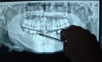 Mandible Fracture Panoramic Radiograph