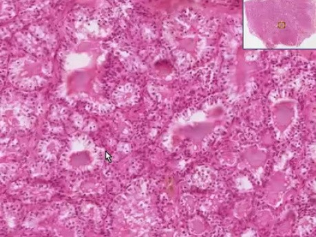 Graves Disease - Histopathology of thyroid