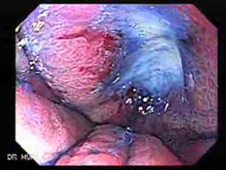 Hourglass Stomach - Chromoendoscopy, Part 3