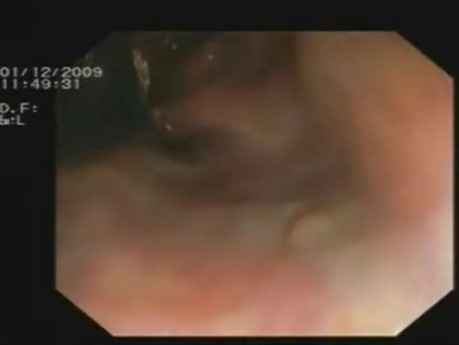 Sigmoid Colon - Rectal  Cancer - Small Polyp And Anorectal Varices 