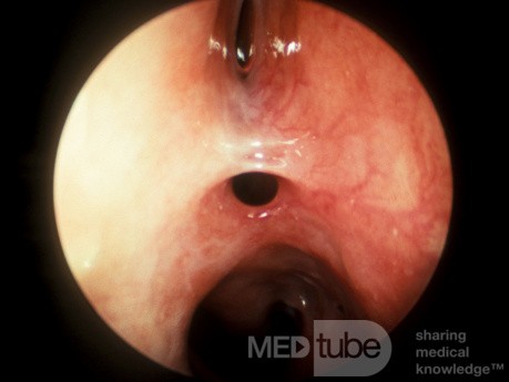 Postoperative Synechiae