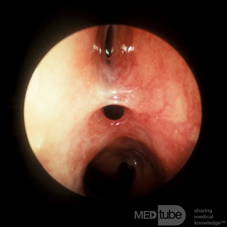 Postoperative Synechiae