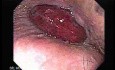 Prolapsed Hemorrhoid (1 of 4)