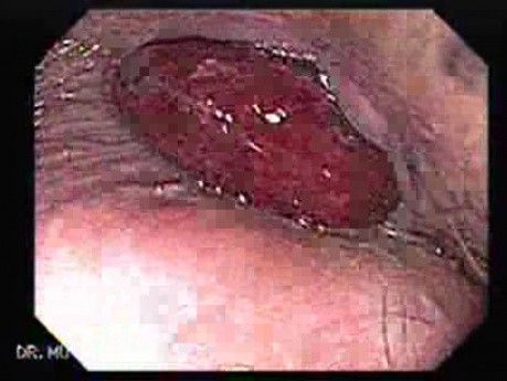 Prolapsed Hemorrhoid (1 of 4)