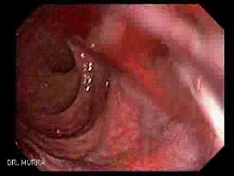Ulcerated Internal Hemorrhoid (2 of 4)