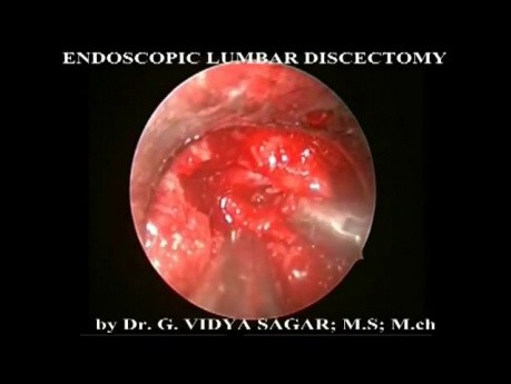 Endoscopic Lumbar Discectomy 