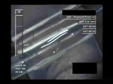Cataract Surgery I - 3