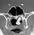 Rhinolith CT Scan