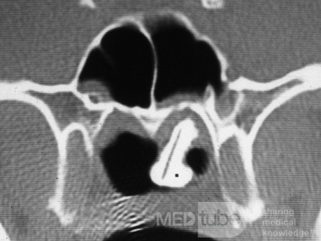 Rhinolith CT Scan