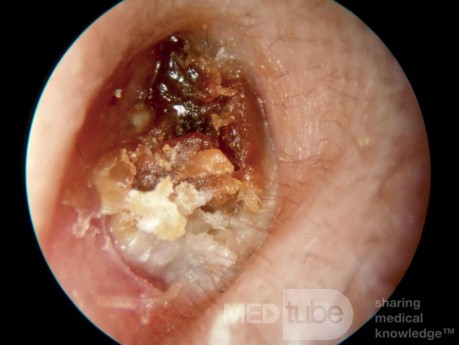 Keratosis Obturans Occluding External Canal