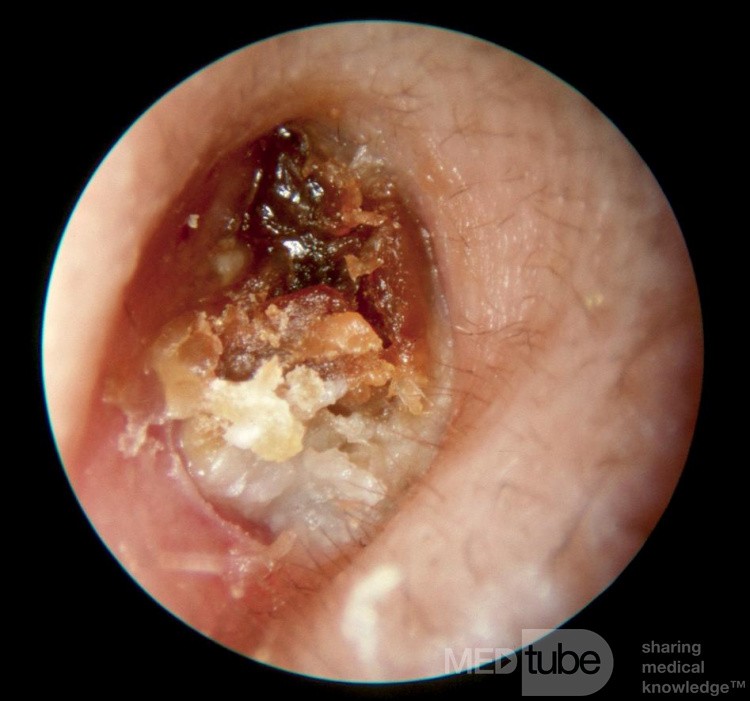 Keratosis Obturans Occluding External Canal