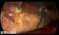 Dual-port Trans-subclavian Thyroid Endoscopic Surgery (Part 4)