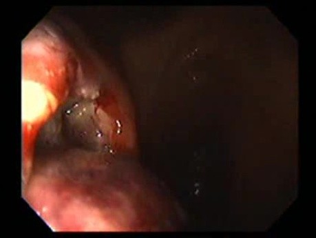 Gastrointestinal Stromal Tumor - GIST (24 of 65)