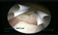 4.5cm SM Fibroid Removal Through Bipolar Resectoscope